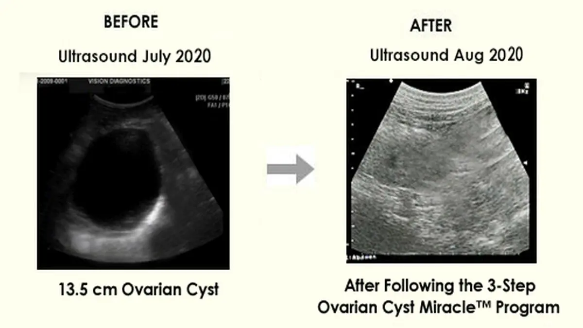 Ovarian Cyst Miracle Program